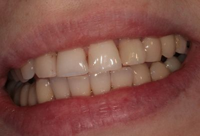 Zubni implantaty Brno _ vnitřní bělení